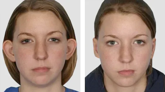 Otoplastia, antes e depois (caso 1)