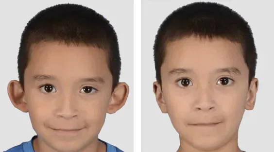 Otoplastia, antes e depois (caso 2)