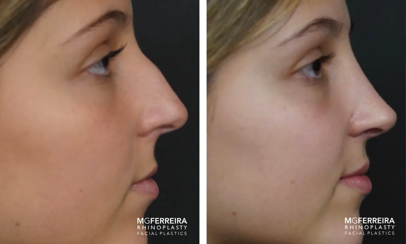 Resultado de rinoplastia do Prof. Dr. Miguel Gonçalves Ferreira, antes e depois (caso 2)