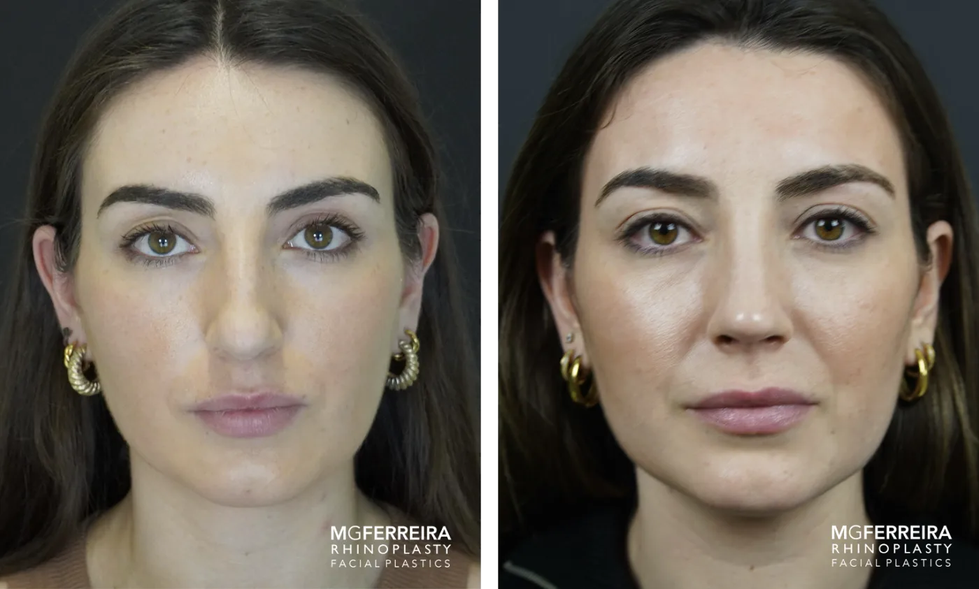 Resultado de rinoplastia do Prof. Dr. Miguel Gonçalves Ferreira, antes e depois (caso 3)