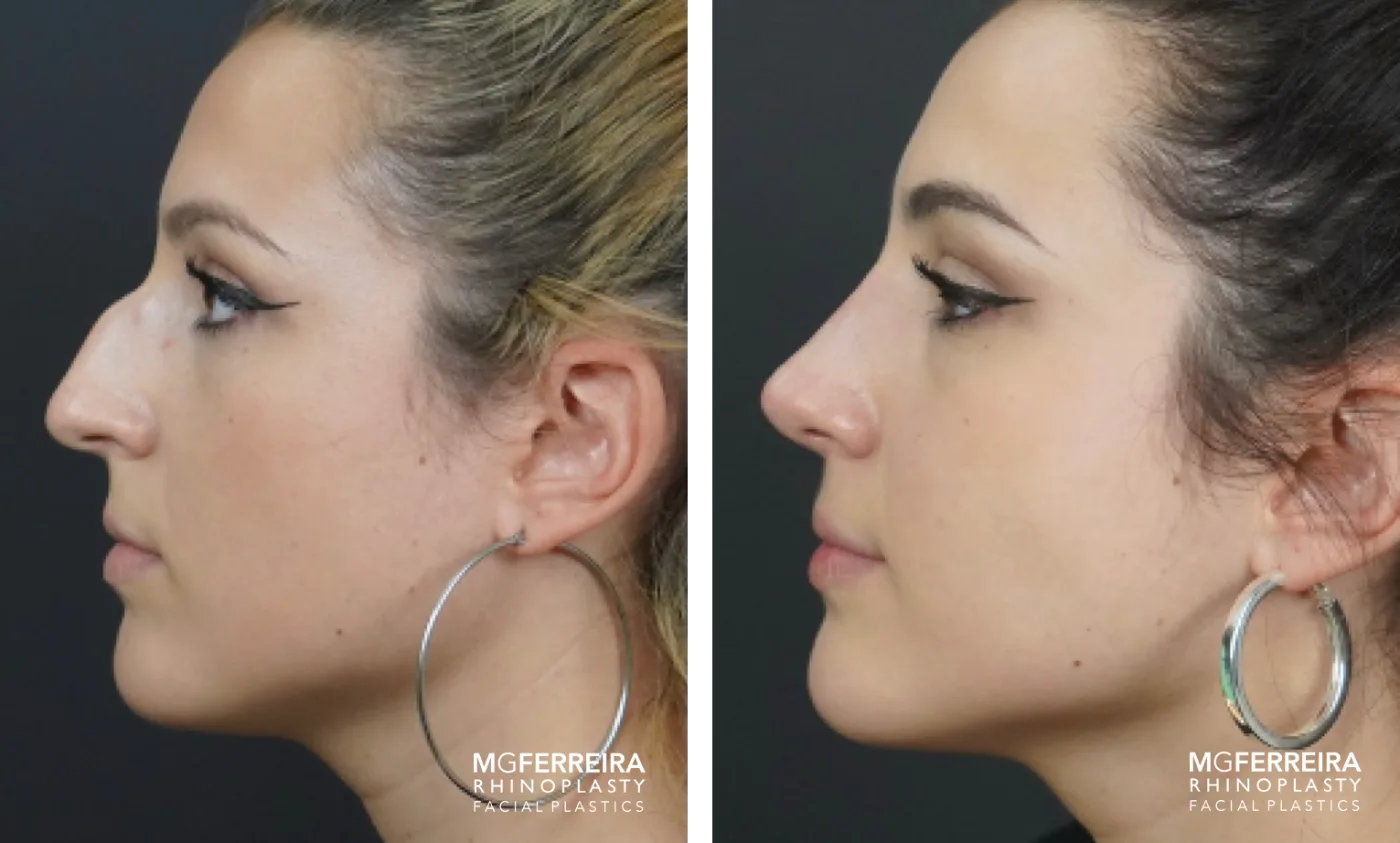 Resultado de rinoplastia do Prof. Dr. Miguel Gonçalves Ferreira, antes e depois (caso 4)