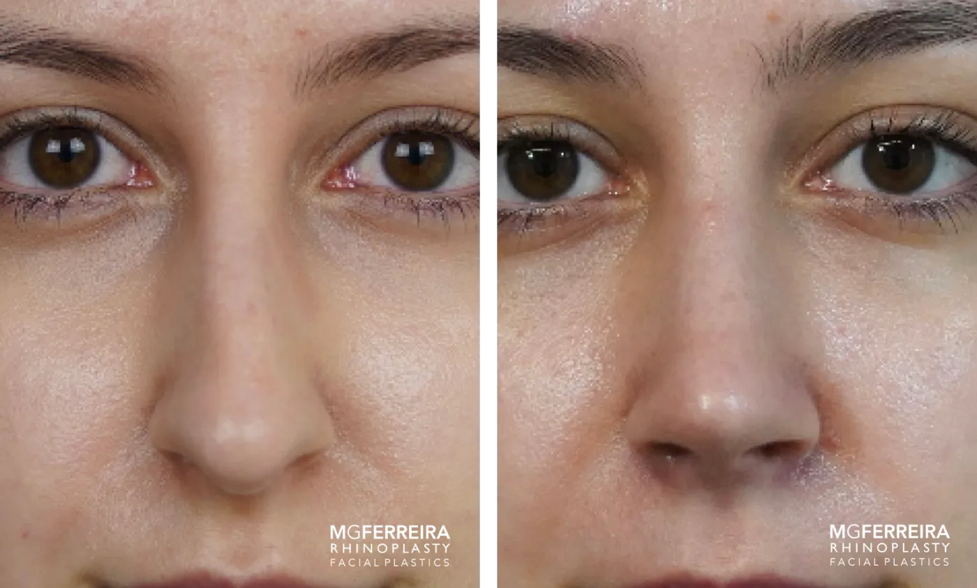 Resultado de rinoplastia do Prof. Dr. Miguel Gonçalves Ferreira, antes e depois (caso 5)