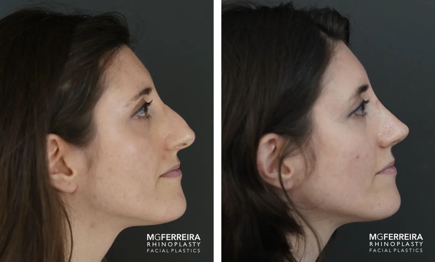 Resultado de rinoplastia do Prof. Dr. Miguel Gonçalves Ferreira, antes e depois (caso 1)