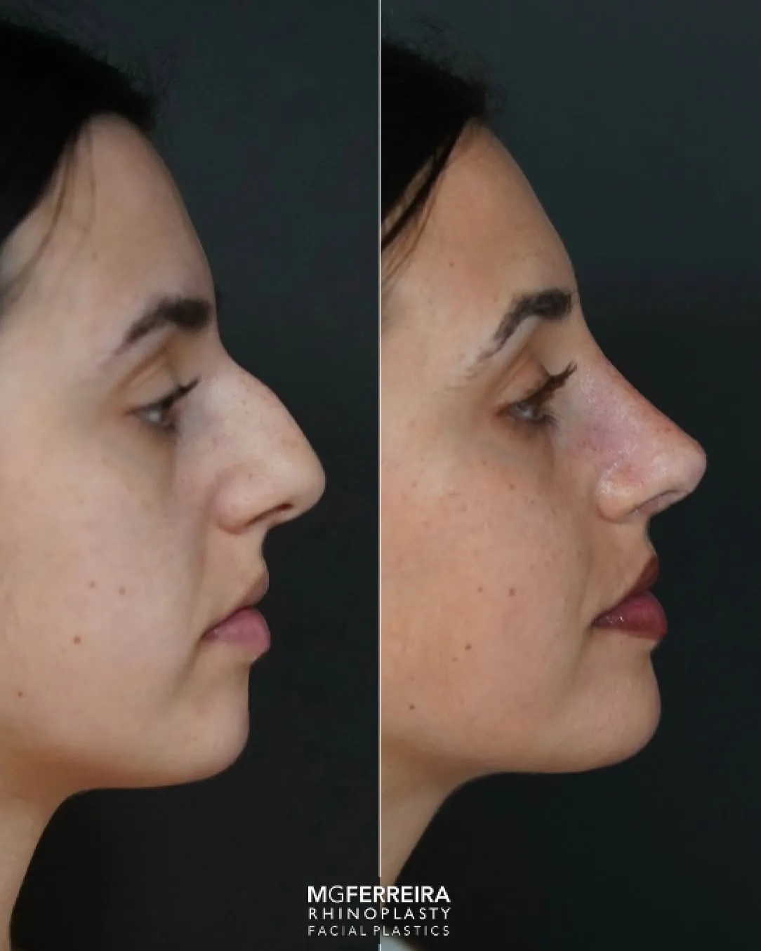 Rinomegalia: nariz grande, giba e desvio nasal, perfil