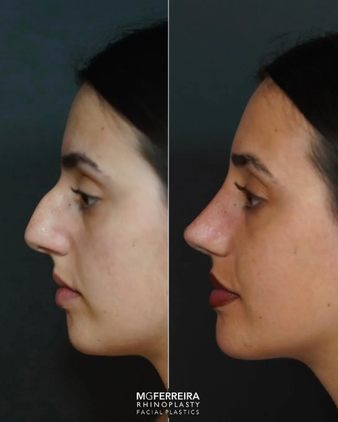 Rinomegalia: nariz grande, giba e desvio nasal, perfil oposto