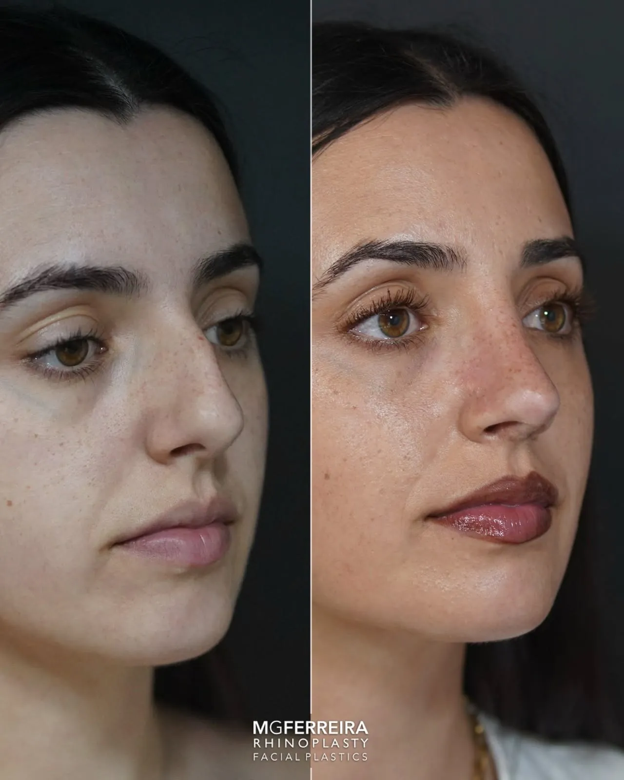 Rinomegalia: nariz grande, giba e desvio nasal, vista oblíqua