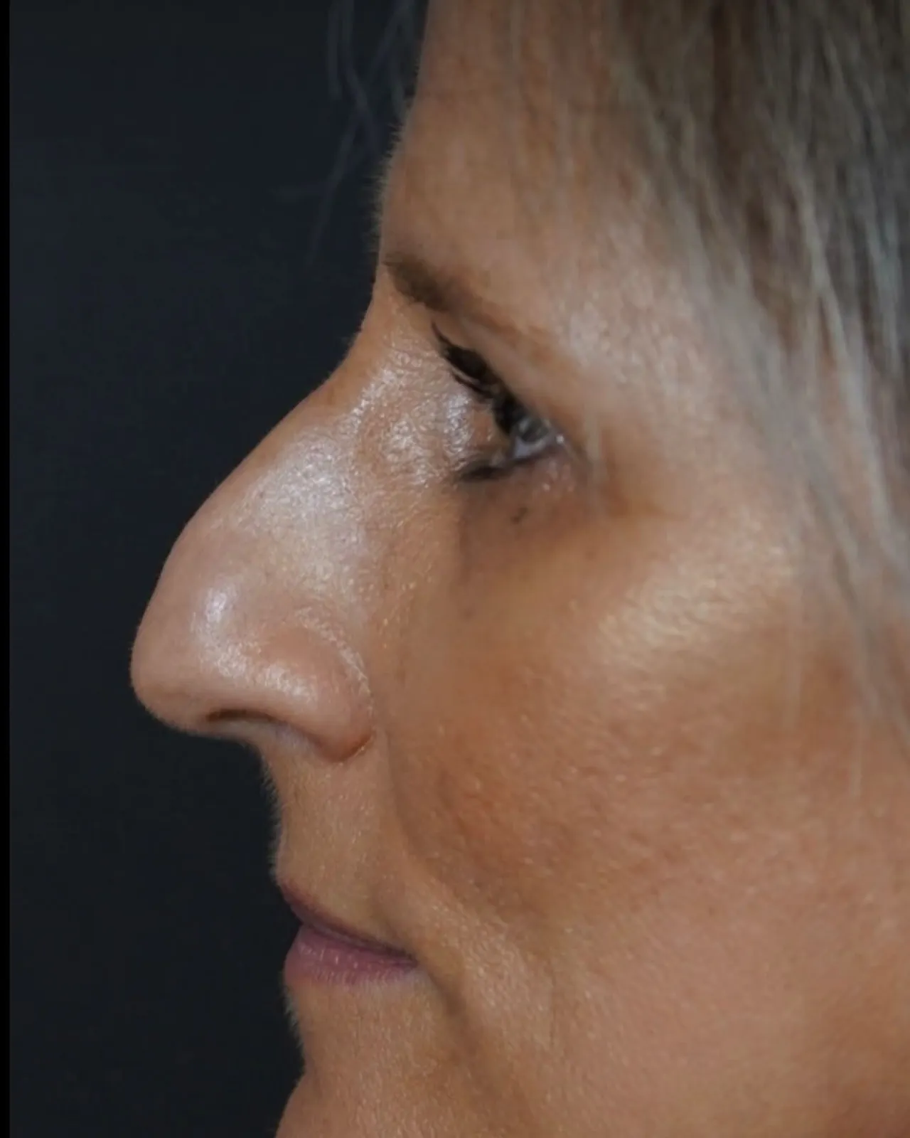 Rinoplastia: comparação de perfil e vistas oblíquas, perfil, fotografia individual 1