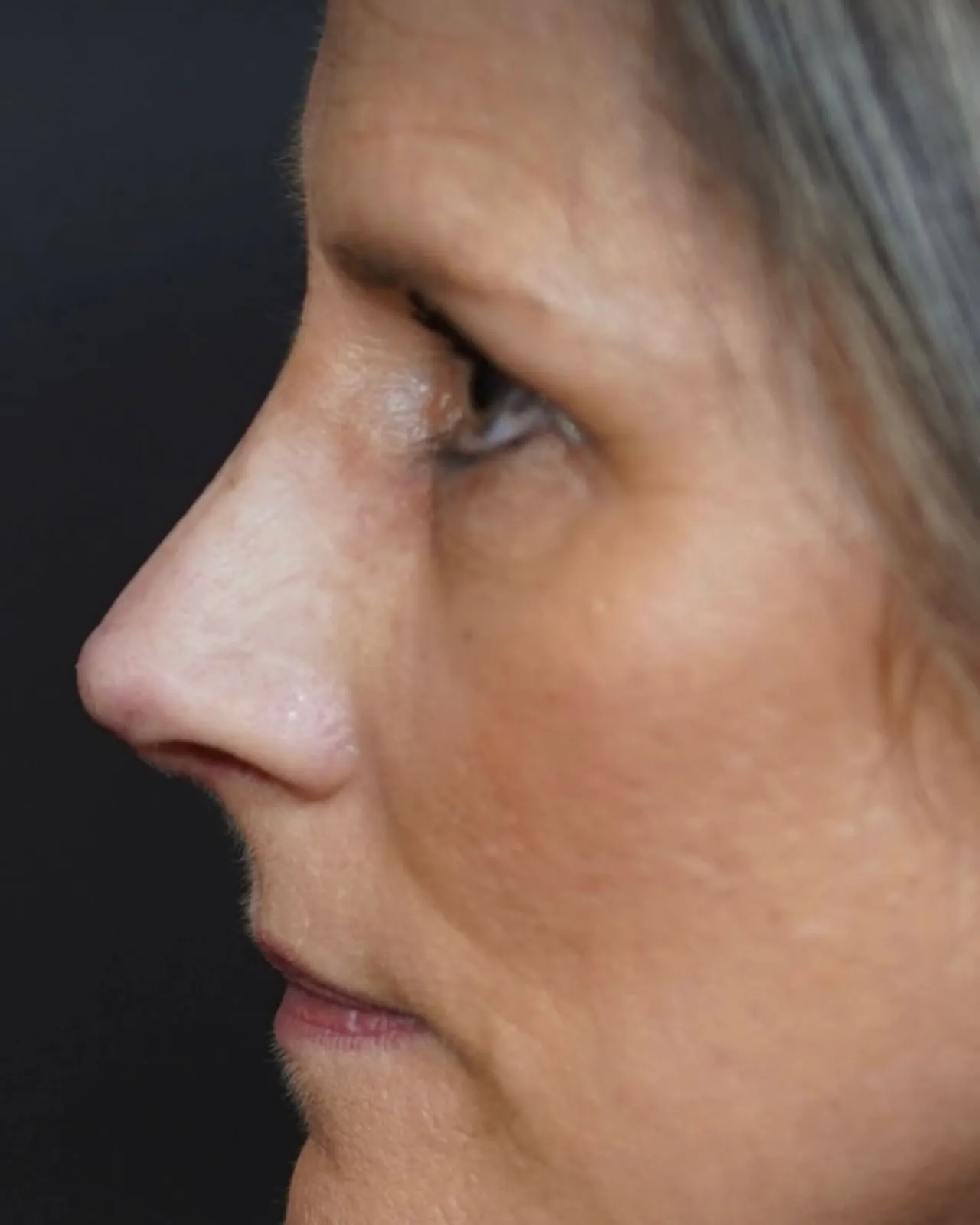 Rinoplastia: comparação de perfil e vistas oblíquas, perfil, fotografia individual 2