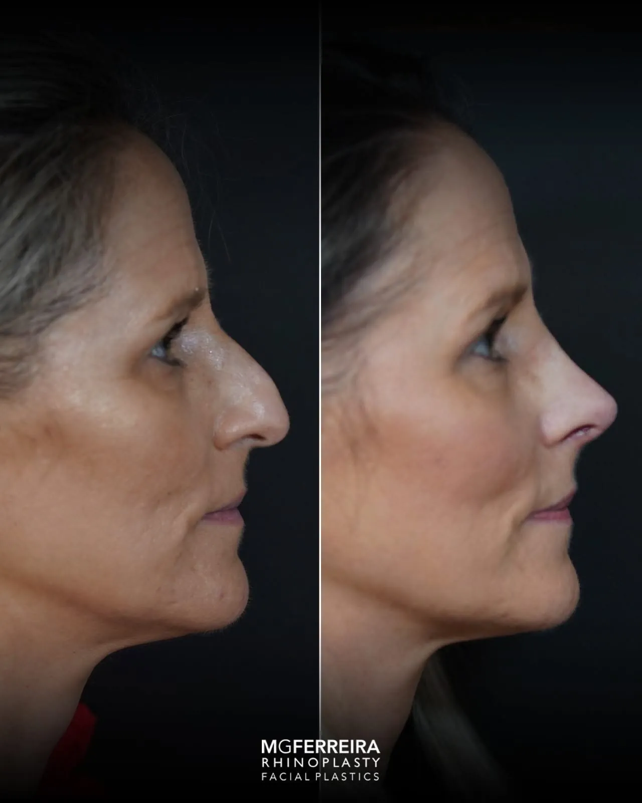 Rinoplastia: comparação de perfil e vistas oblíquas, perfil