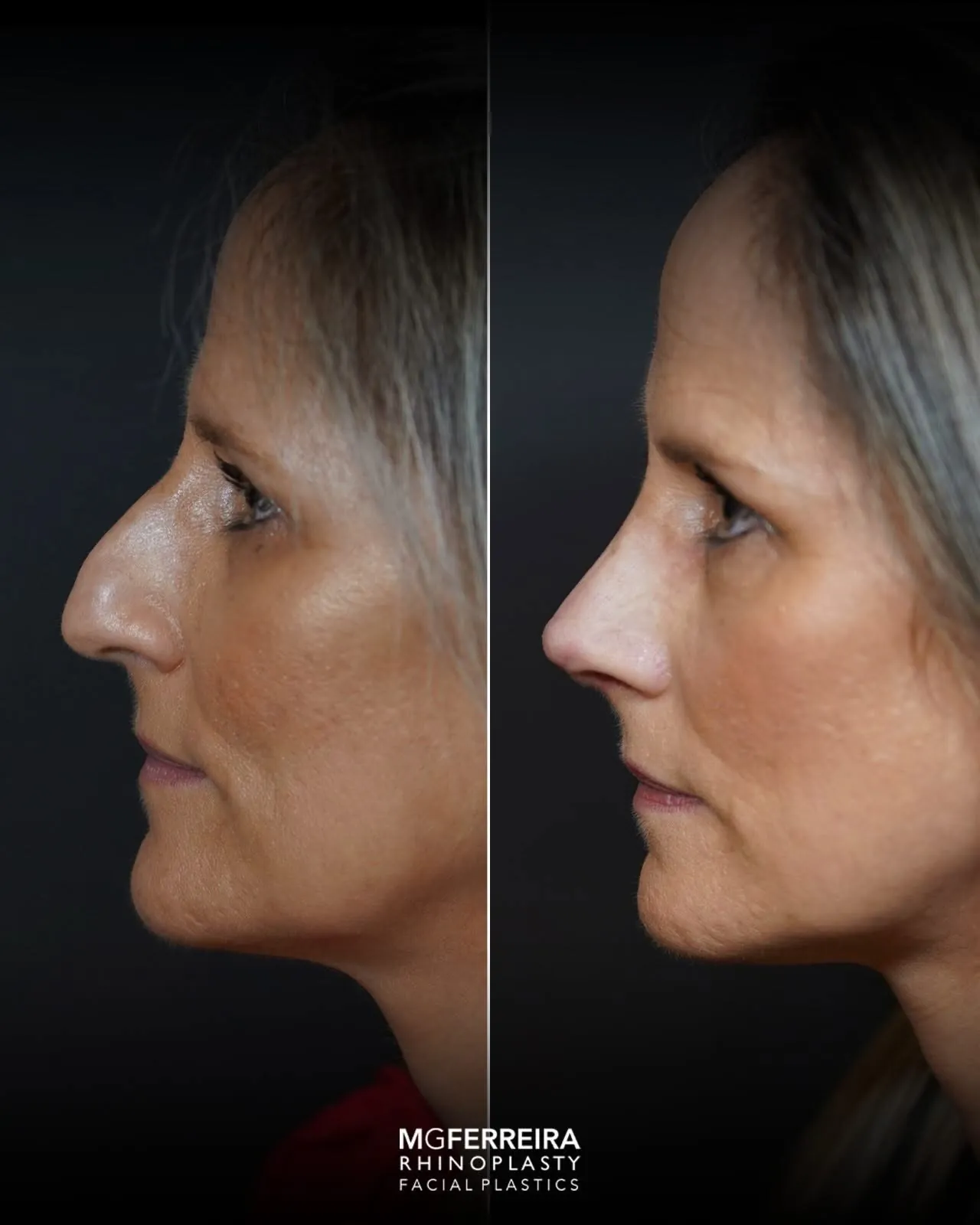 Rinoplastia: comparação de perfil e vistas oblíquas, perfil oposto
