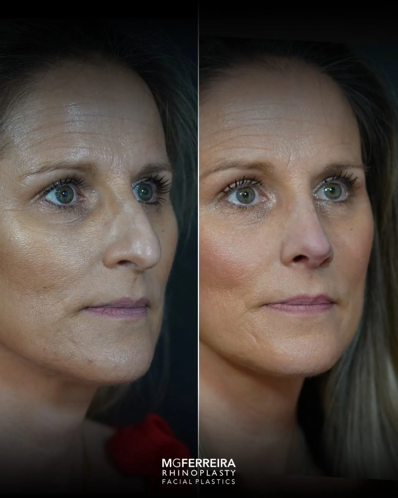 Rinoplastia: comparação de perfil e vistas oblíquas, vista oblíqua