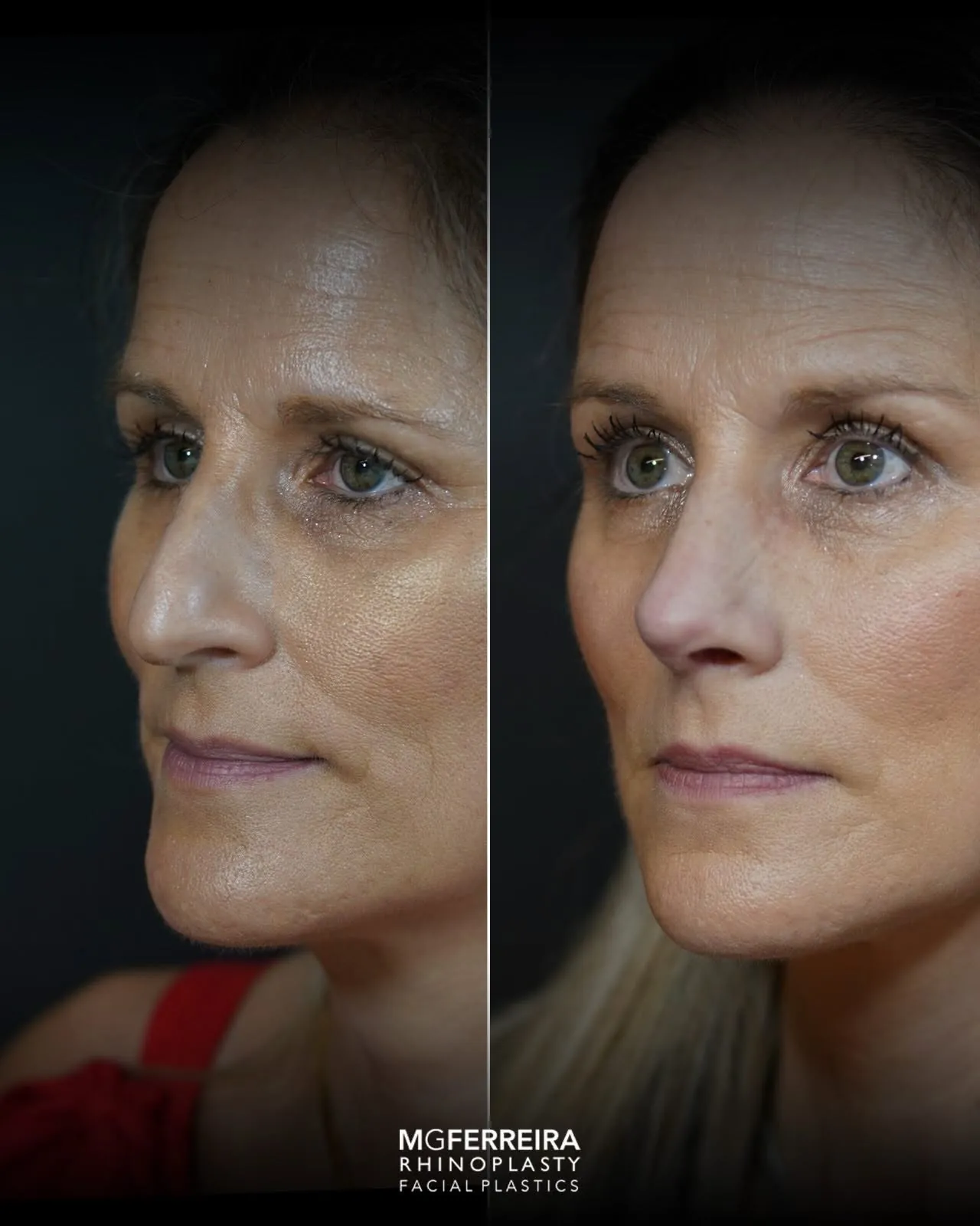 Rinoplastia: comparação de perfil e vistas oblíquas, vista oblíqua oposta