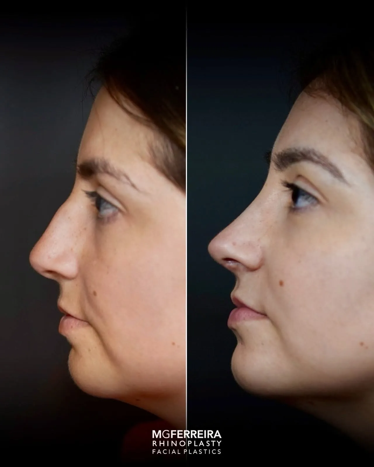 Rinoplastia de preservação: dorso e suporte da ponta, perfil