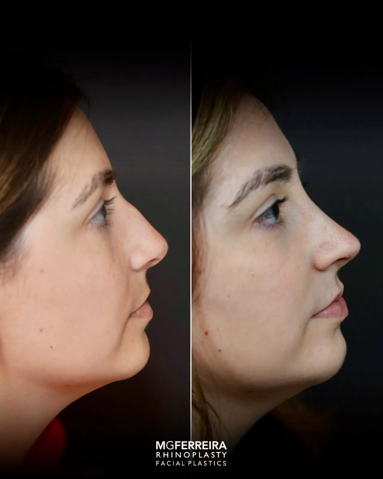 Rinoplastia de preservação: dorso e suporte da ponta, perfil oposto