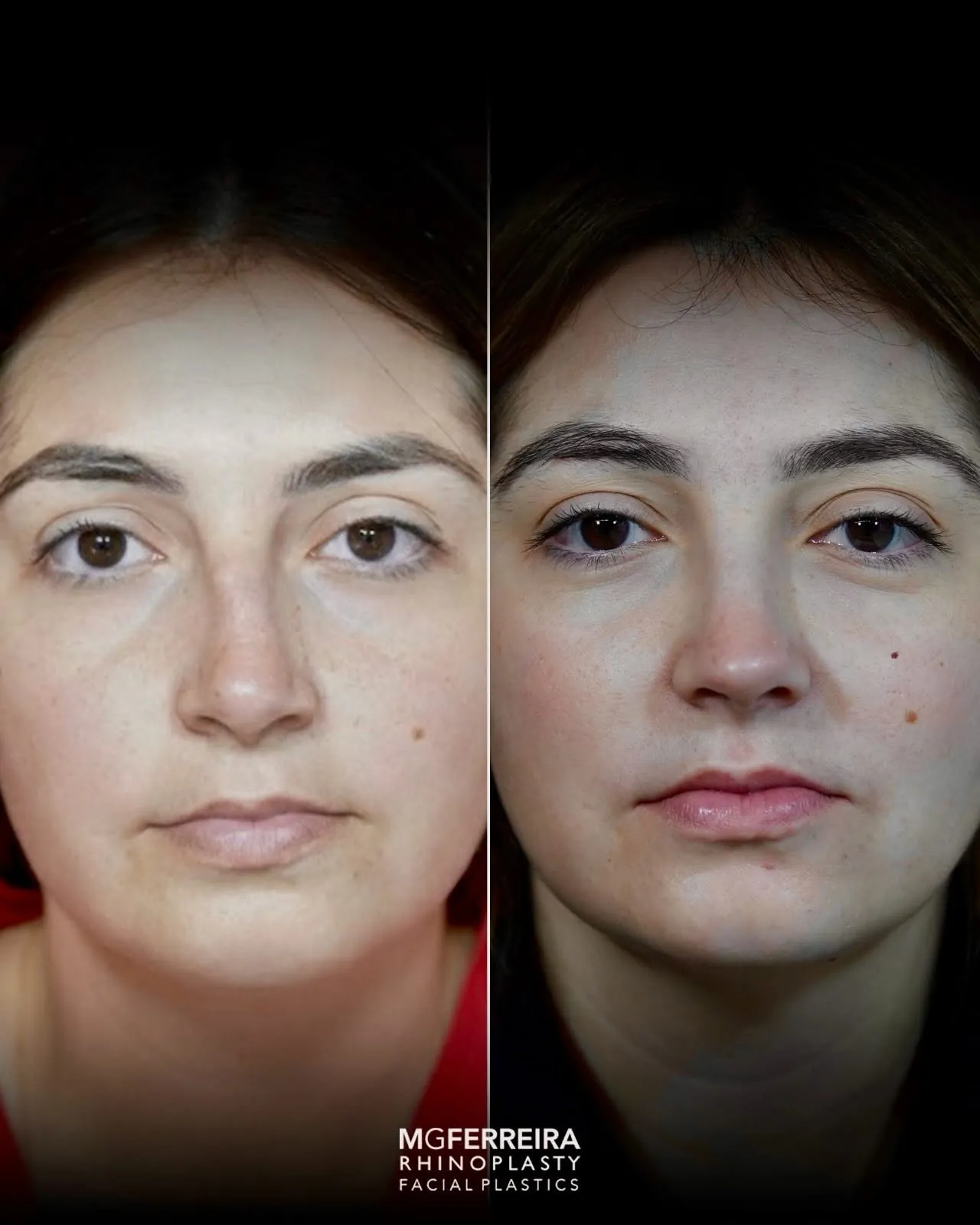 Rinoplastia de preservação: dorso e suporte da ponta, vista frontal