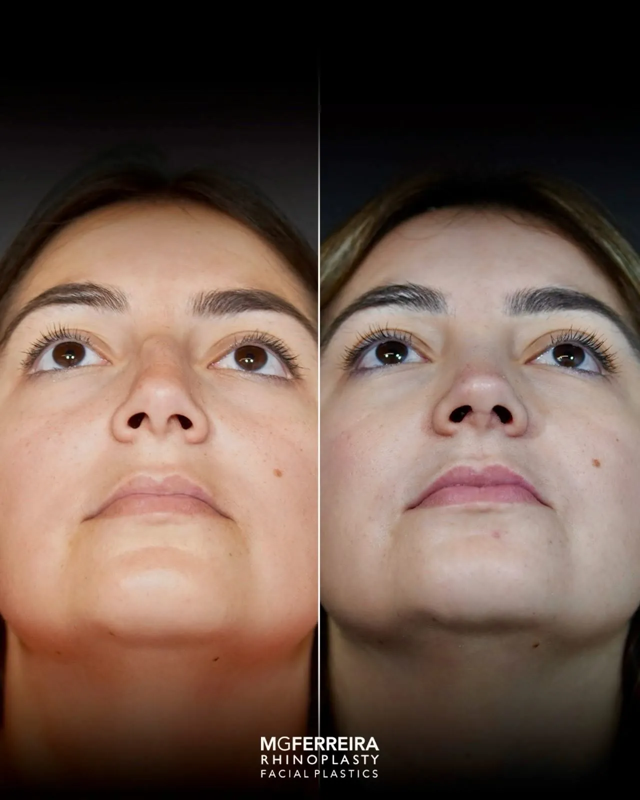 Rinoplastia de preservação: dorso e suporte da ponta, vista inferior