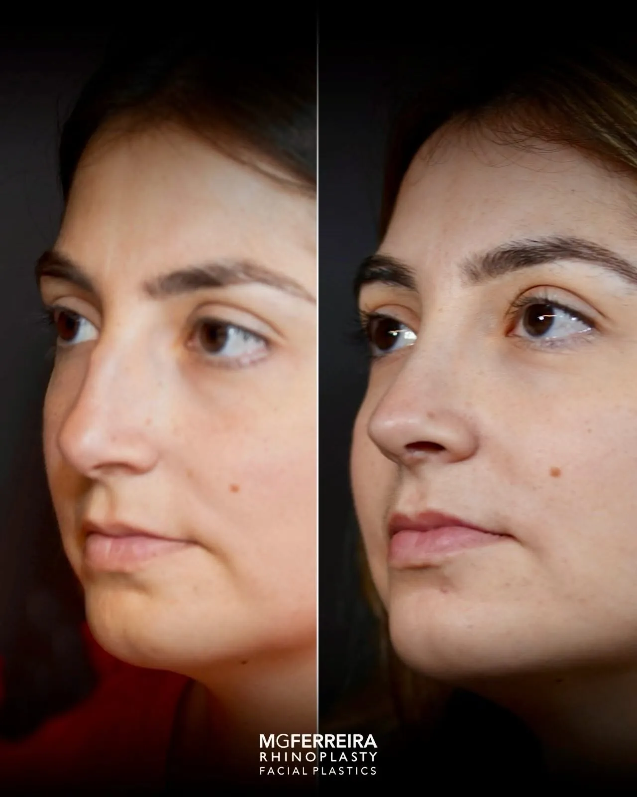 Rinoplastia de preservação: dorso e suporte da ponta, vista oblíqua