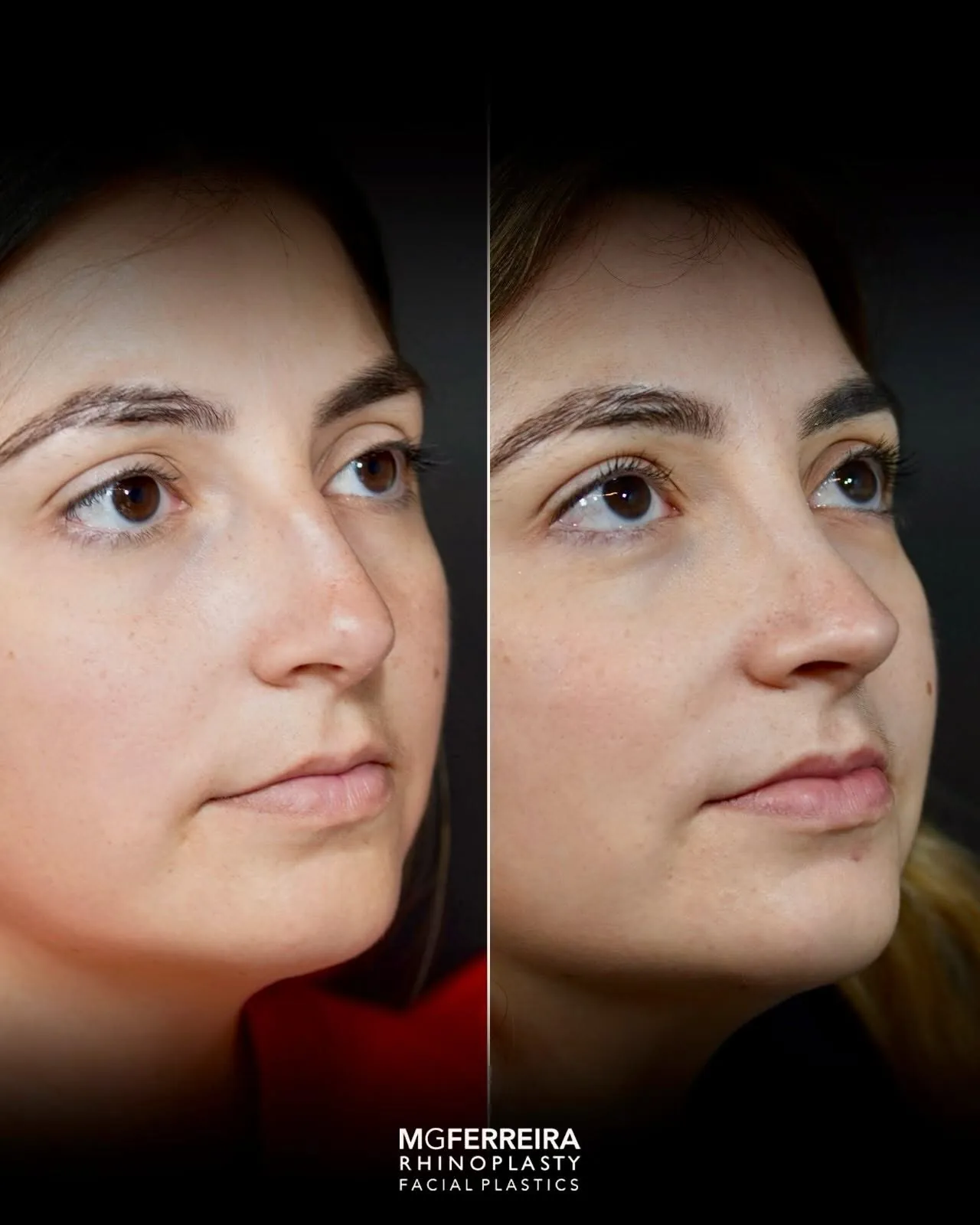 Rinoplastia de preservação: dorso e suporte da ponta, vista oblíqua oposta