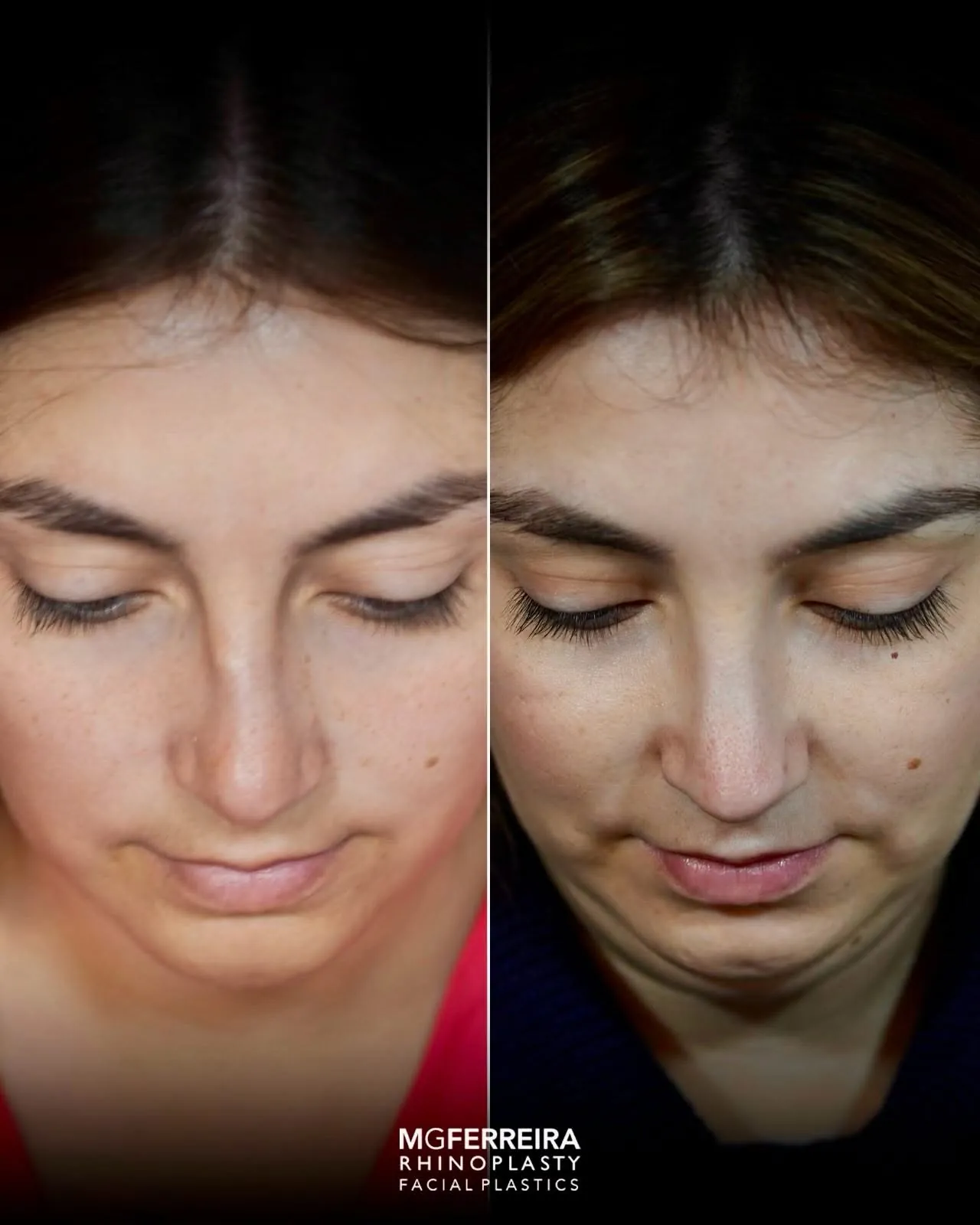 Rinoplastia de preservação: dorso e suporte da ponta, vista superior