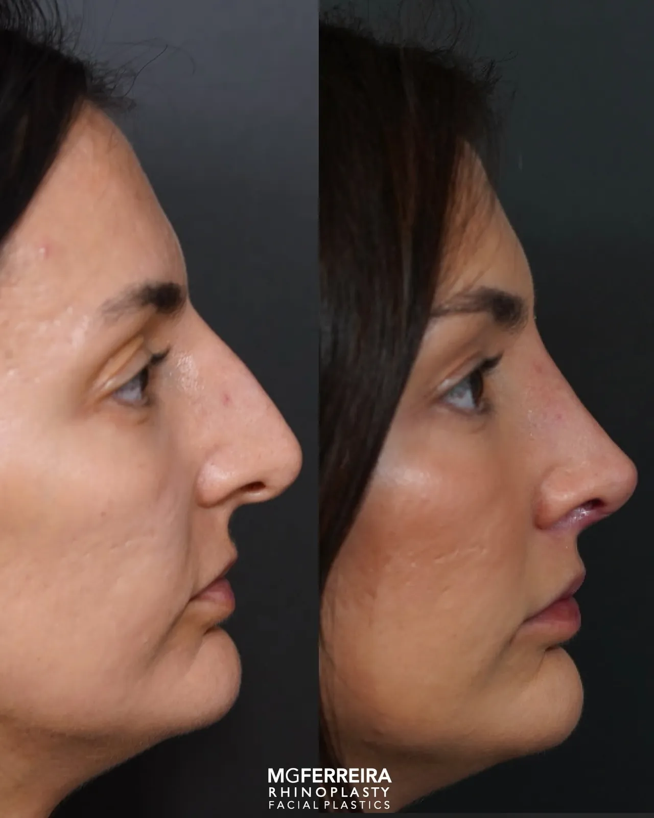 Comparação de perfil, Rinoplastia de preservação: giba acentuada