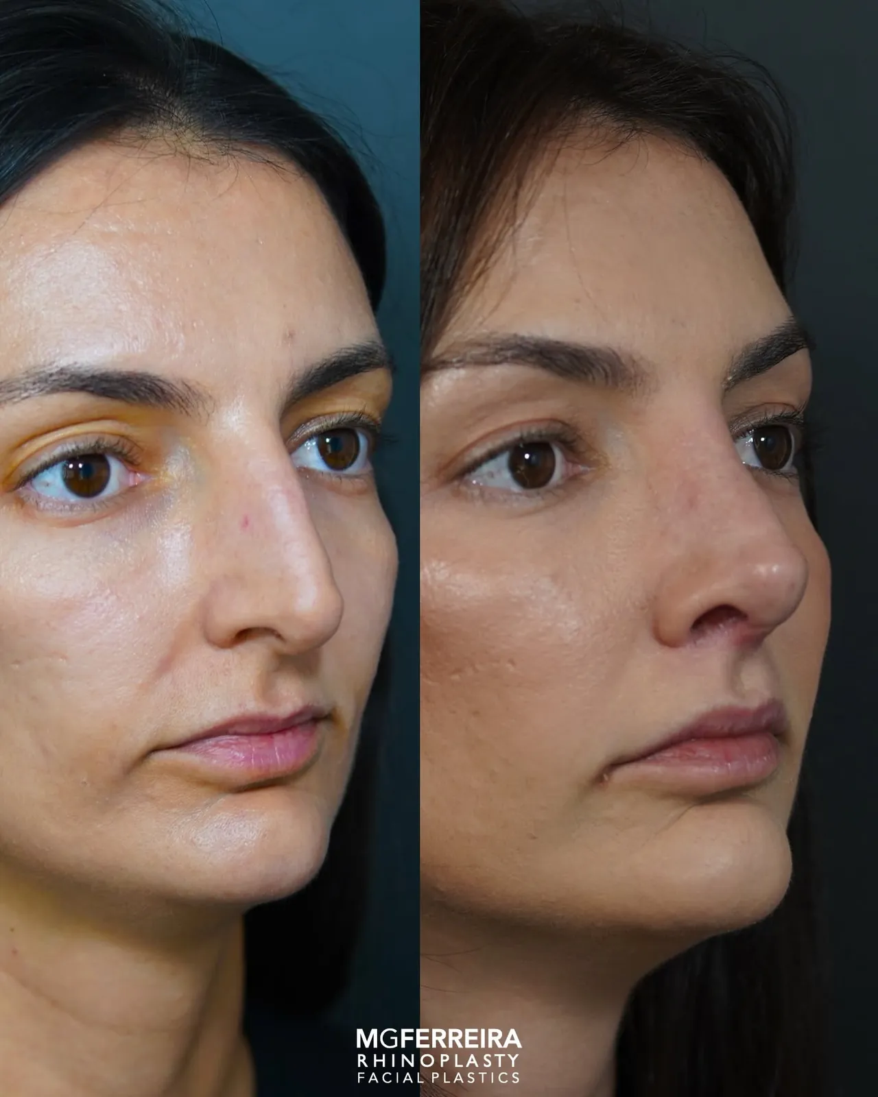 Comparação em vista oblíqua, Rinoplastia de preservação: giba acentuada