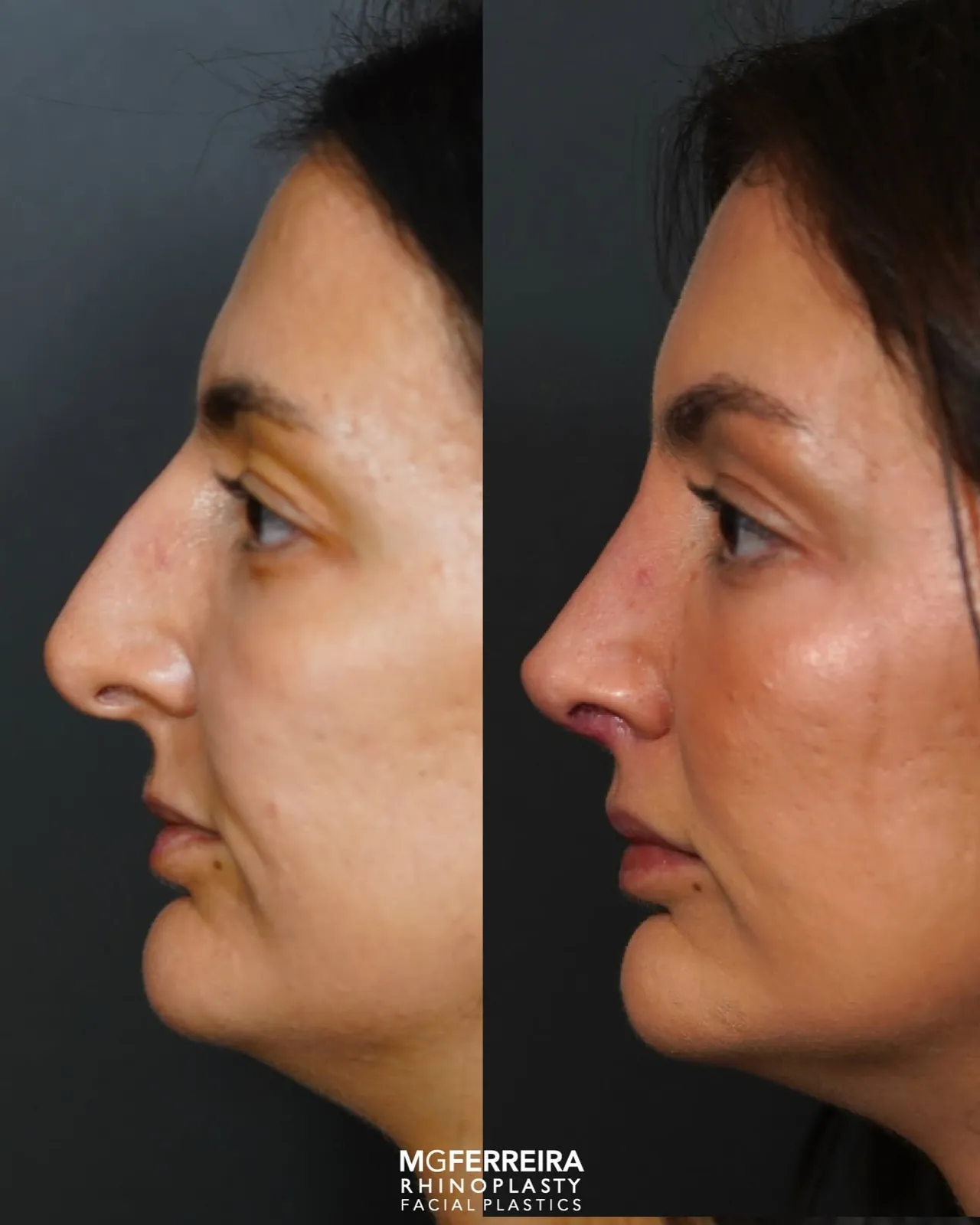 Comparação de perfil oposto, Rinoplastia de preservação: giba acentuada