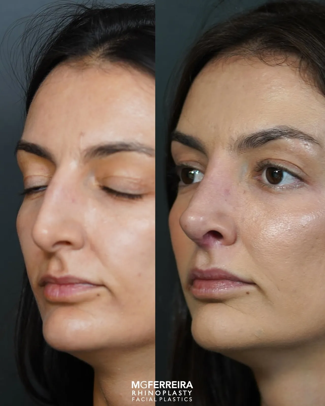Comparação em vista oblíqua oposta, Rinoplastia de preservação: giba acentuada
