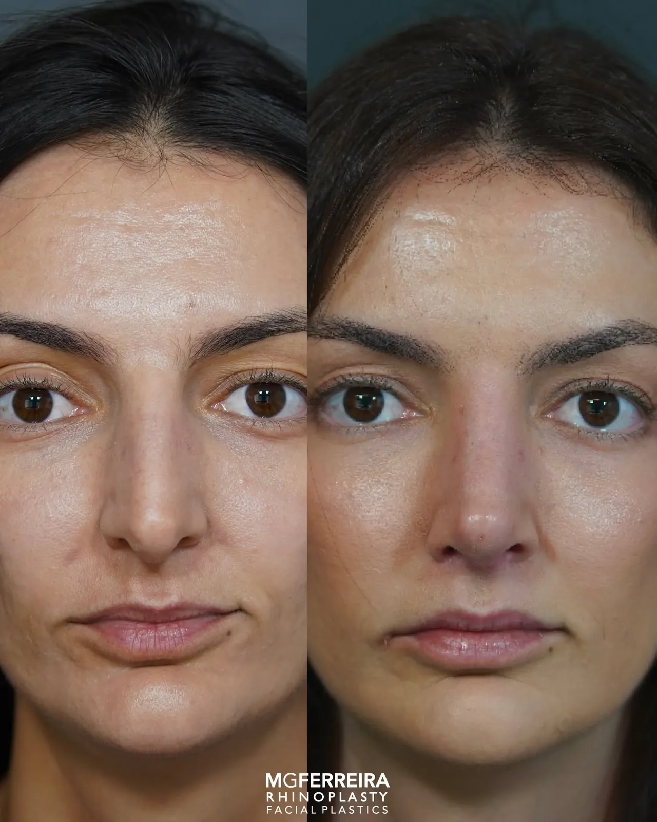 Comparação frontal, Rinoplastia de preservação: giba acentuada