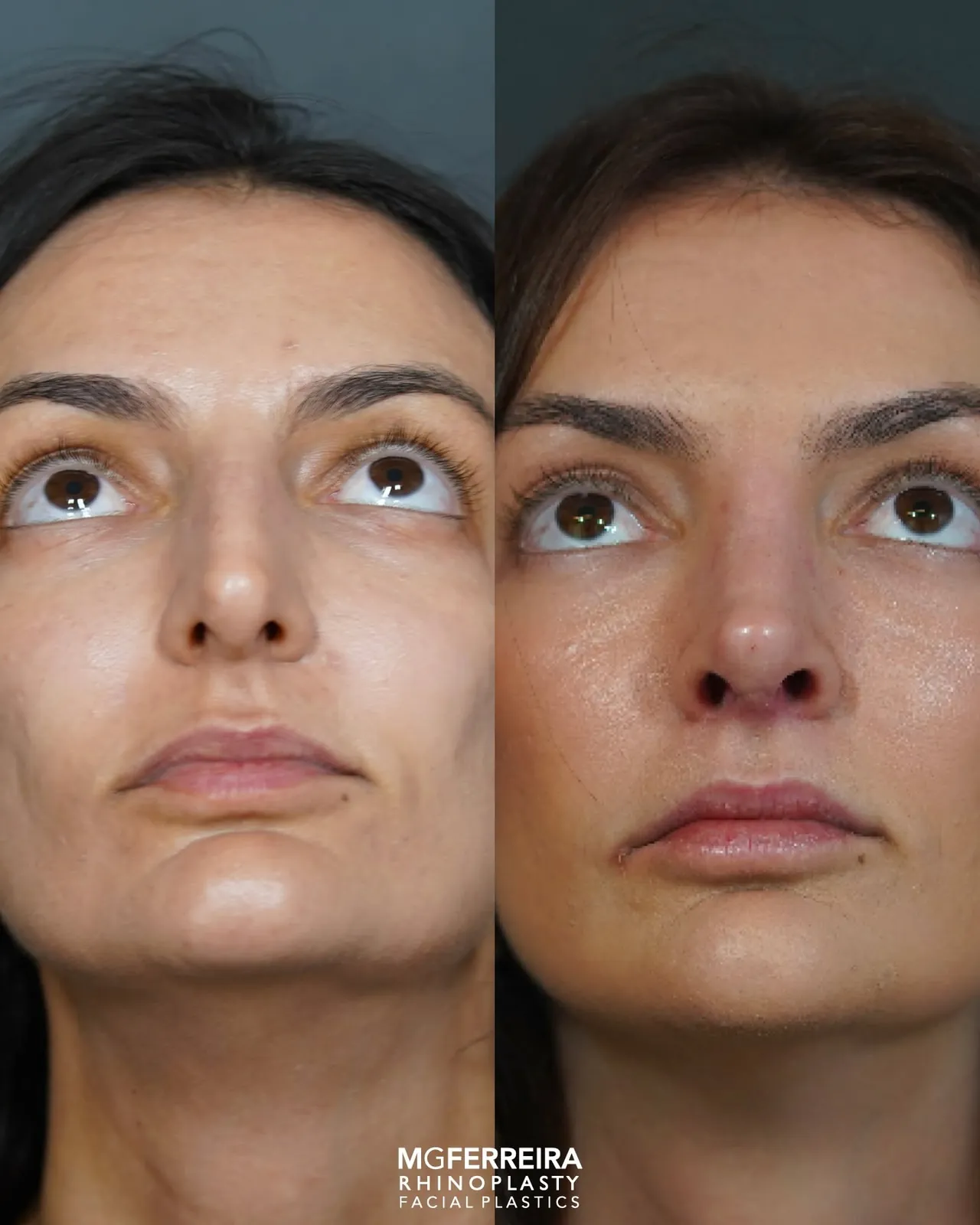 Comparação em vista inferior, Rinoplastia de preservação: giba acentuada