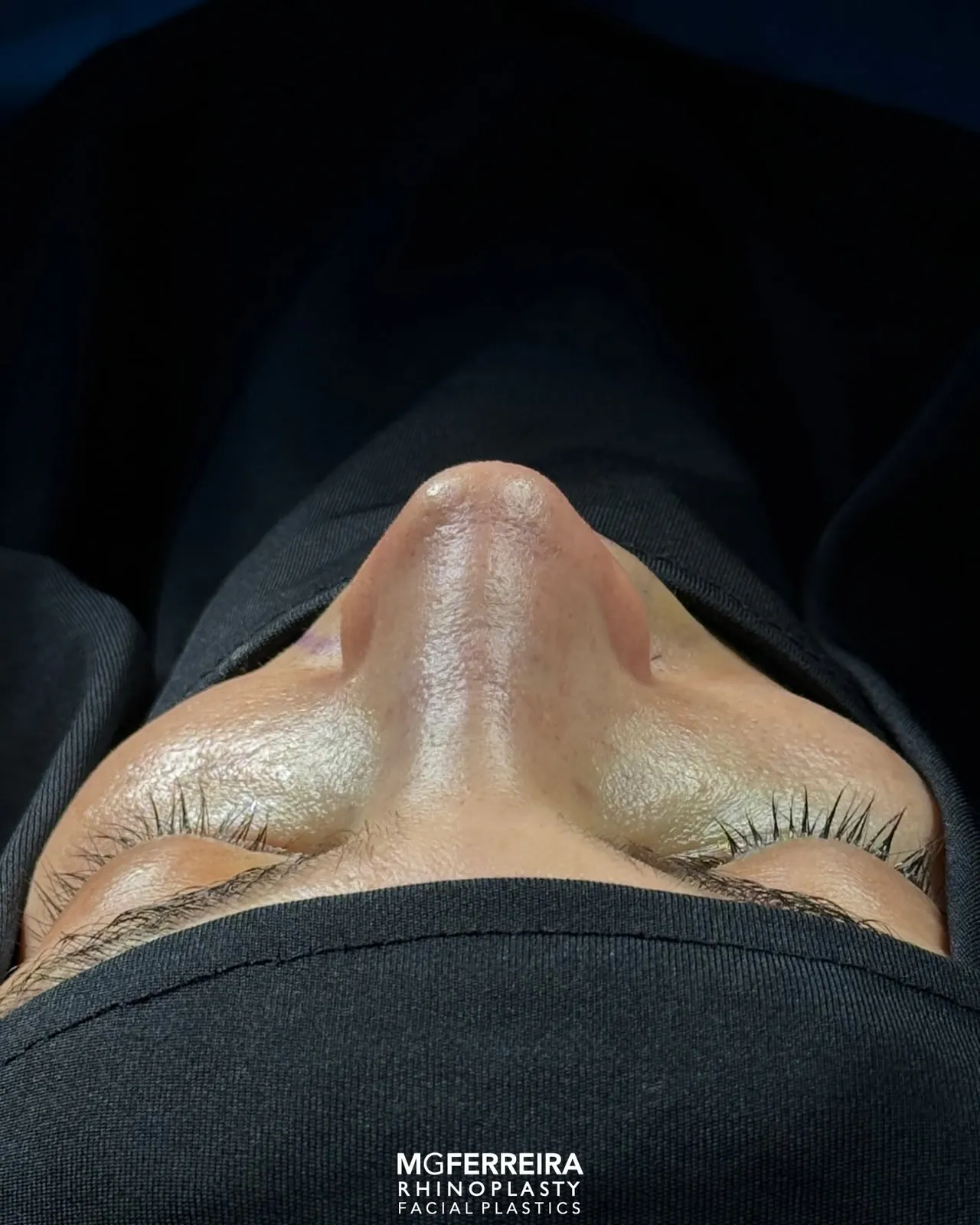 Fotografia em vista inferior, Rinoplastia de preservação: giba acentuada