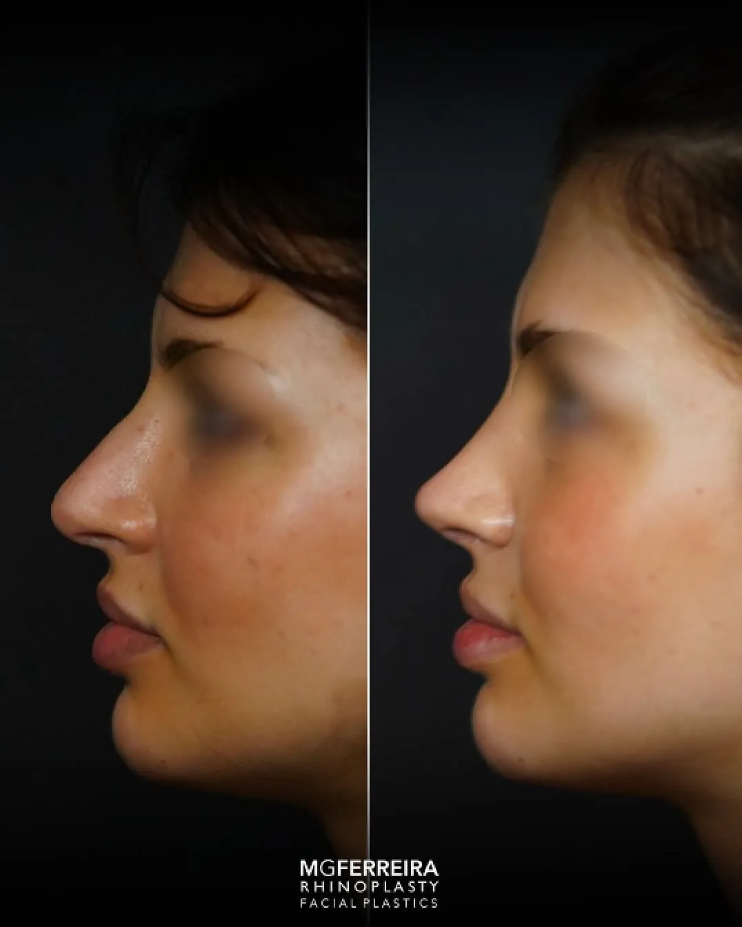 Rinoplastia de revisão: refinamento da ponta nasal, perfil