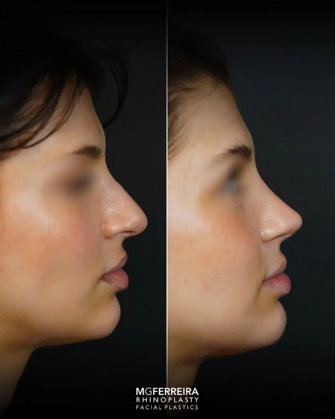 Rinoplastia de revisão: refinamento da ponta nasal, perfil oposto