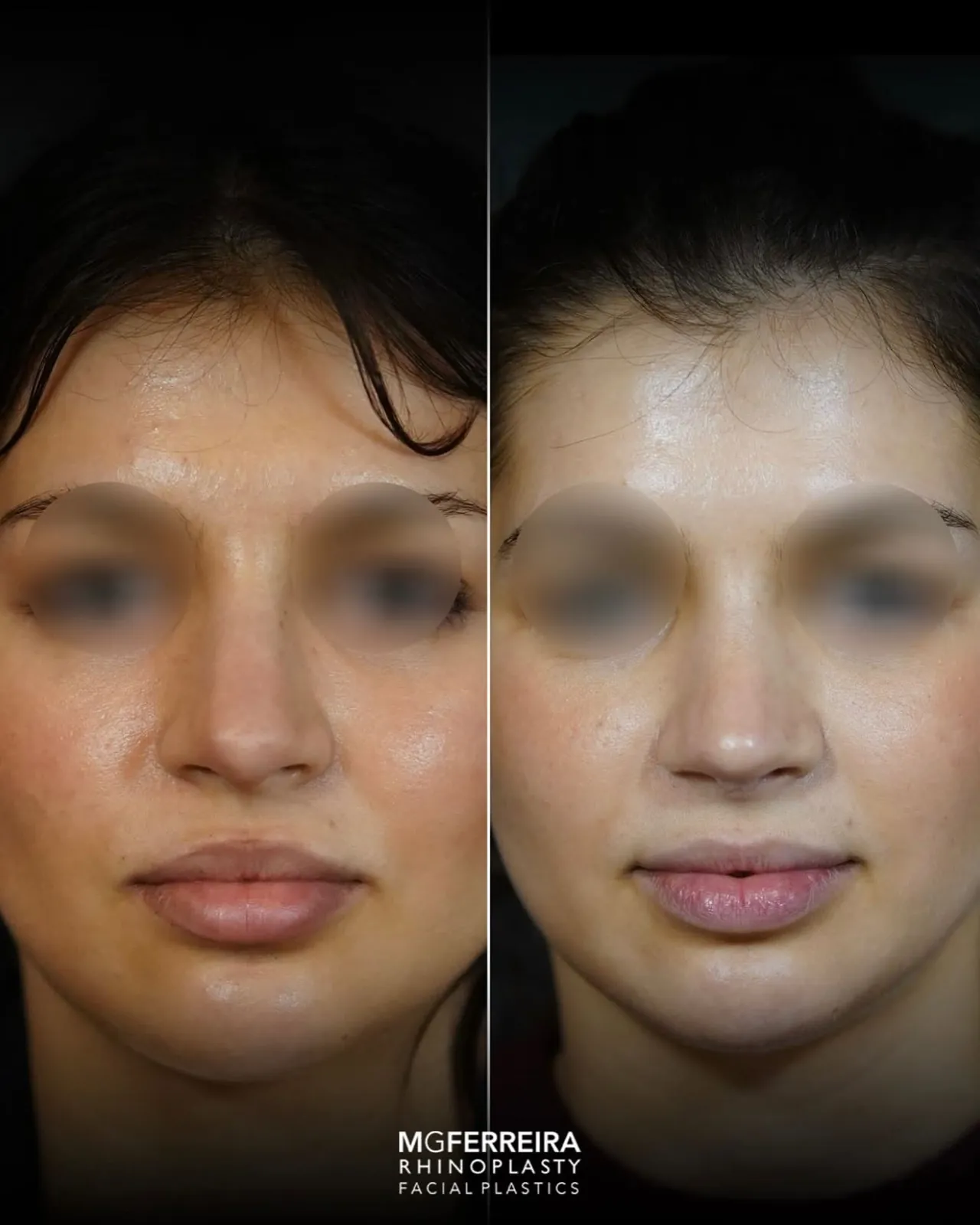 Rinoplastia de revisão: refinamento da ponta nasal, vista frontal