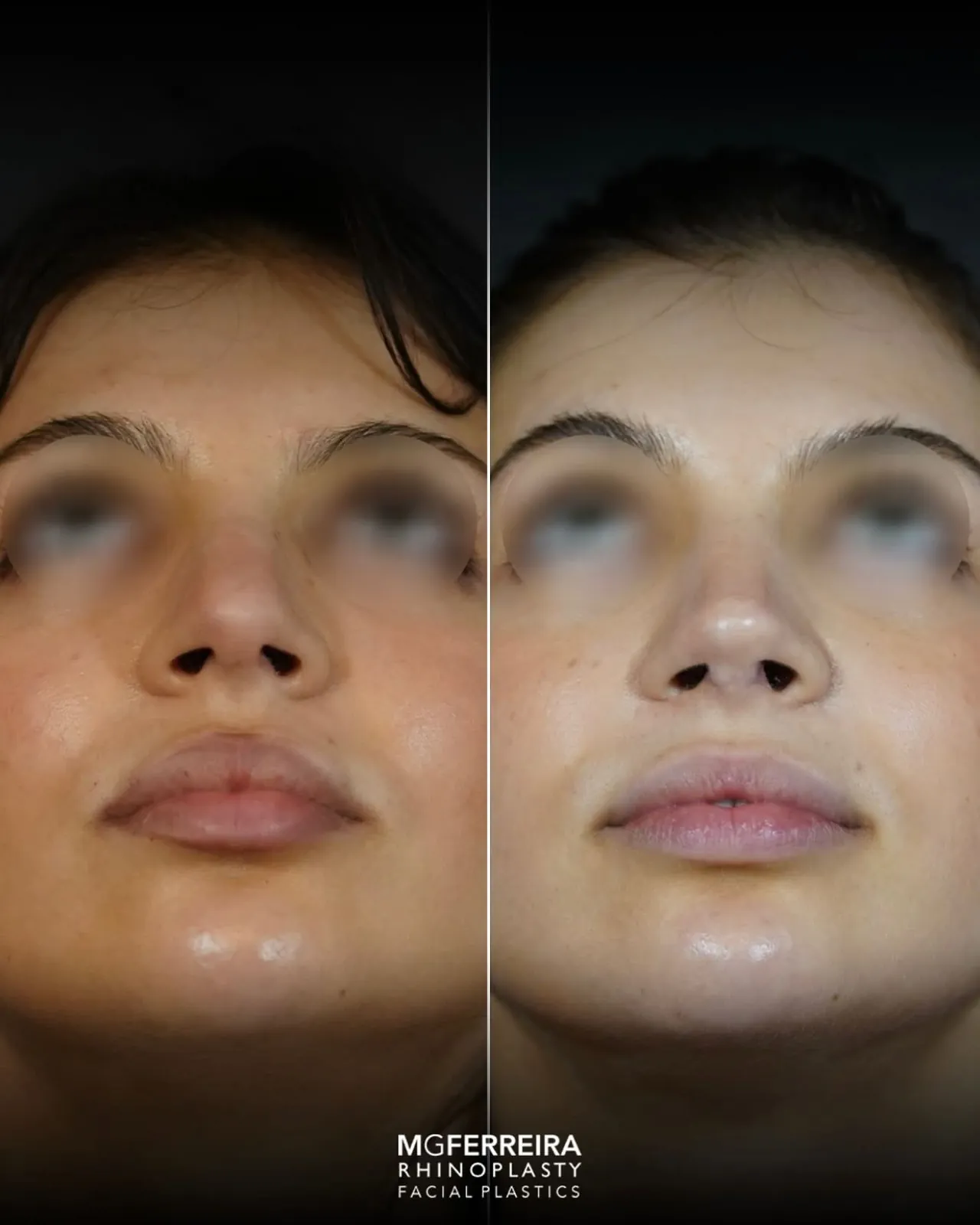 Rinoplastia de revisão: refinamento da ponta nasal, vista inferior