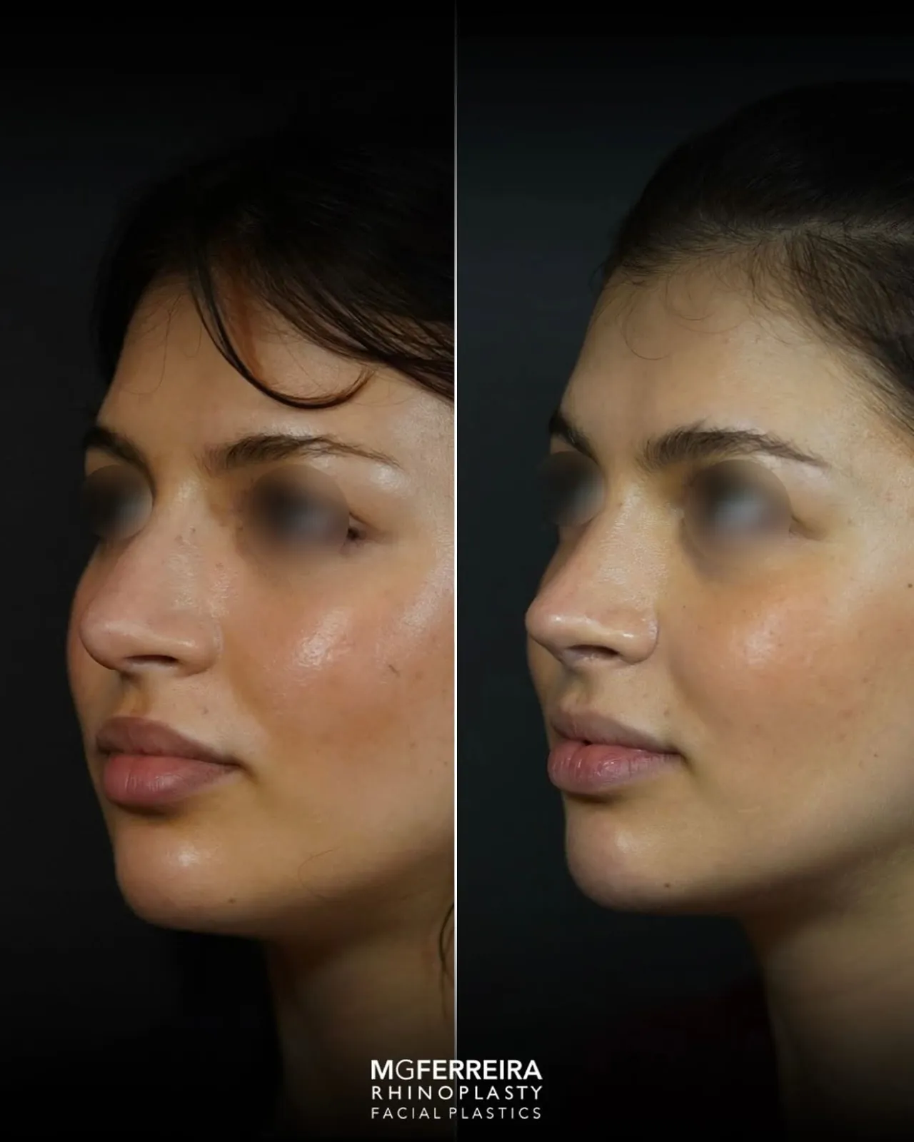 Rinoplastia de revisão: refinamento da ponta nasal, vista oblíqua