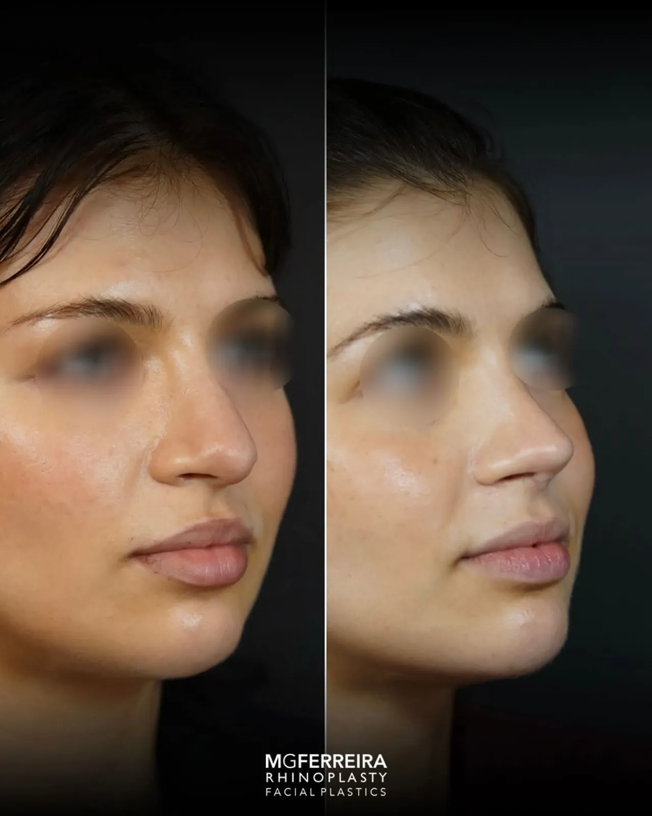 Rinoplastia de revisão: refinamento da ponta nasal, vista oblíqua oposta