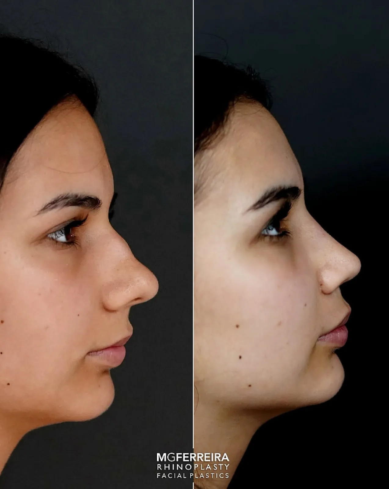Comparação de perfil, Rinoplastia: desvio do terço médio e ponta caída