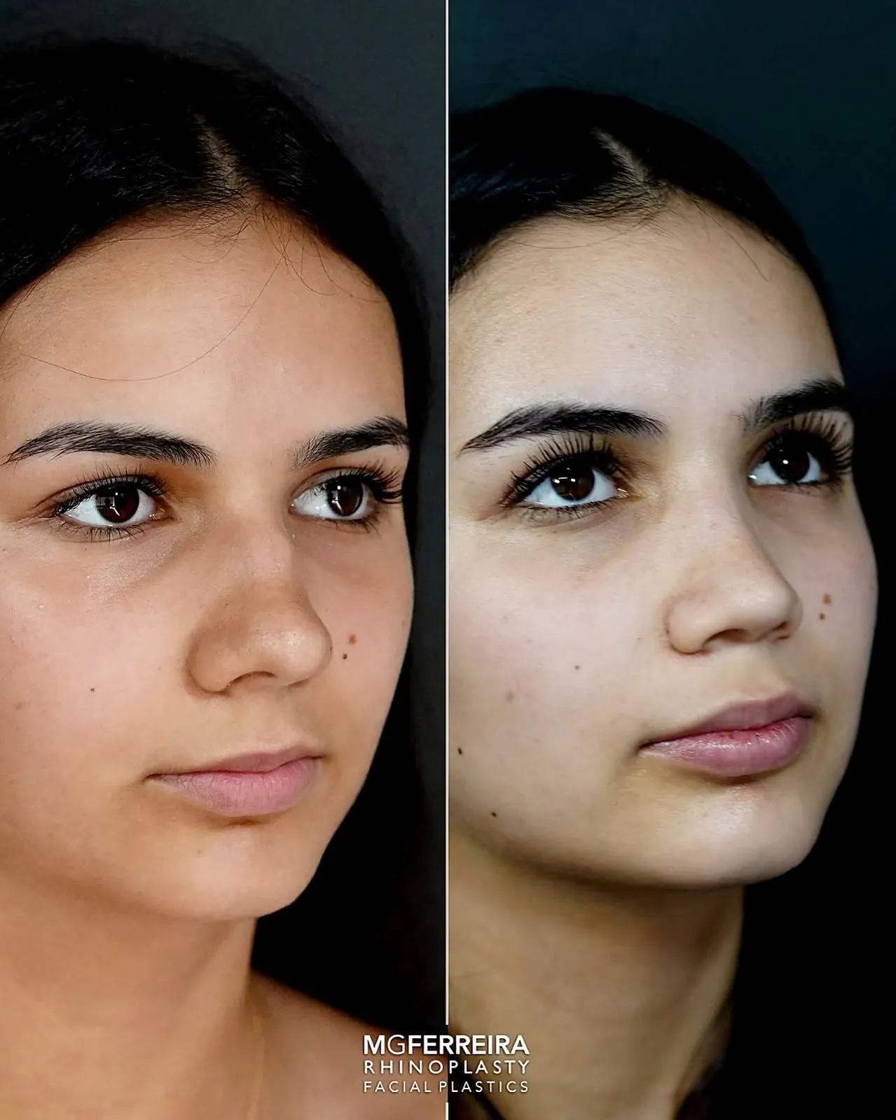 Comparação em vista oblíqua, Rinoplastia: desvio do terço médio e ponta caída