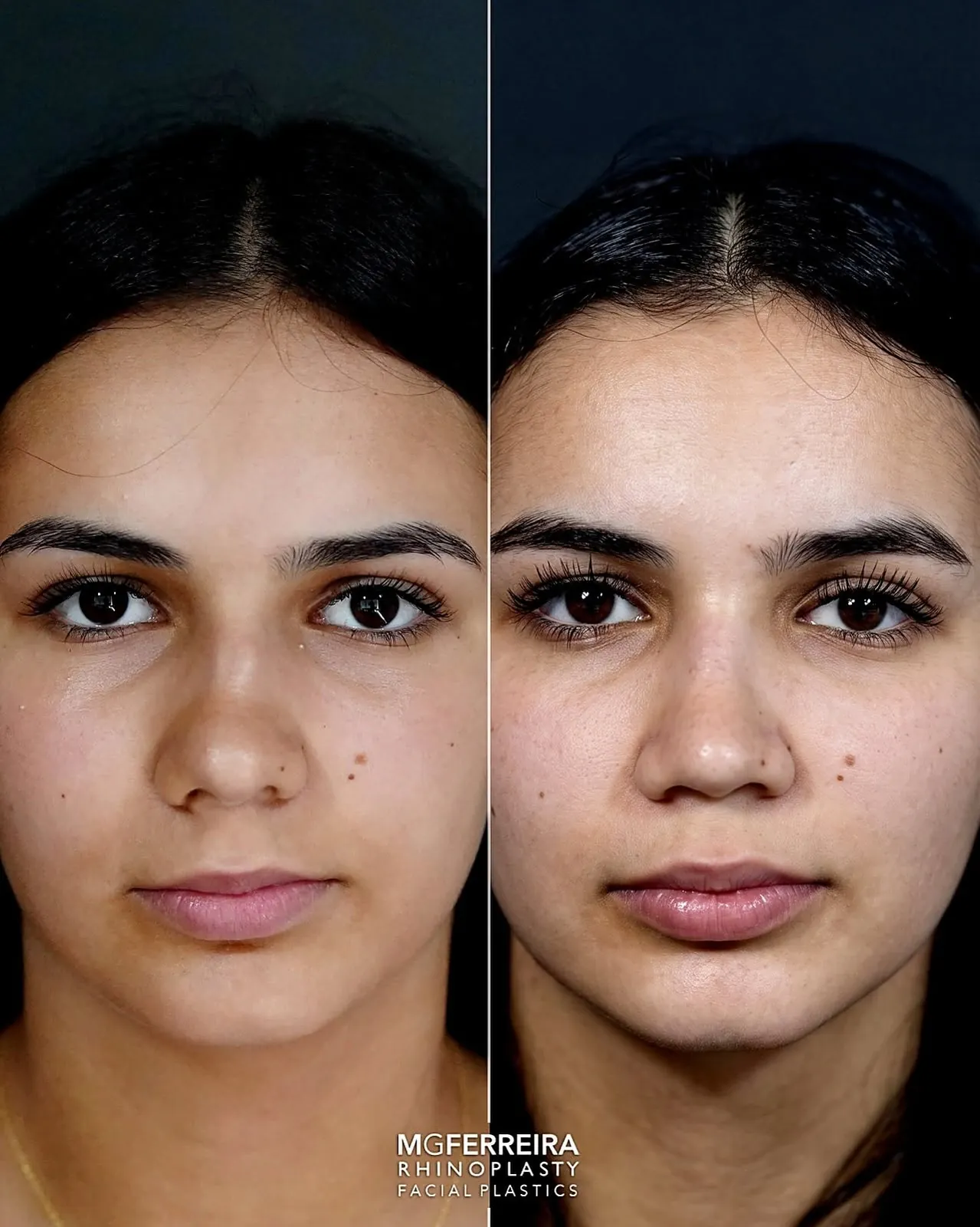 Comparação frontal, Rinoplastia: desvio do terço médio e ponta caída