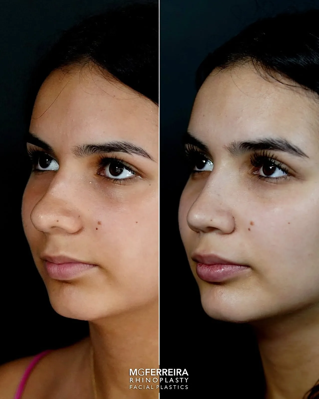 Comparação em vista oblíqua oposta, Rinoplastia: desvio do terço médio e ponta caída