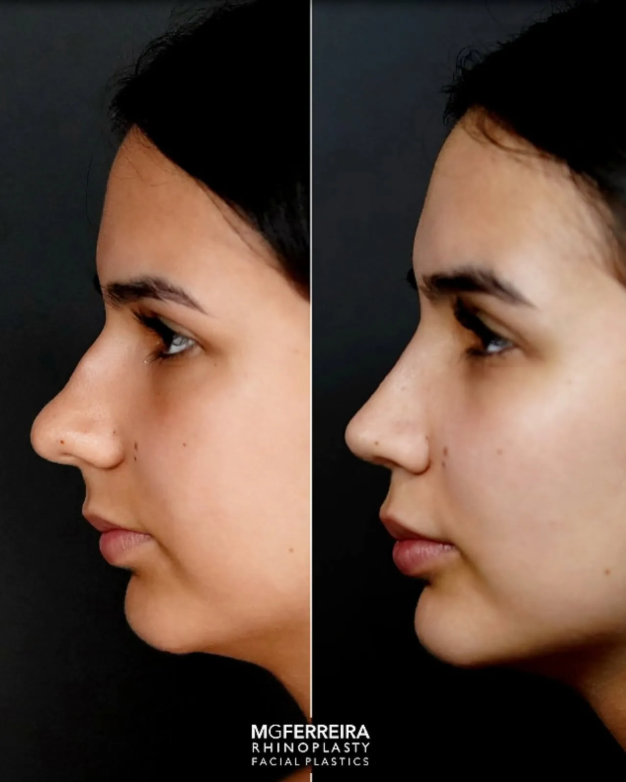 Comparação de perfil oposto, Rinoplastia: desvio do terço médio e ponta caída