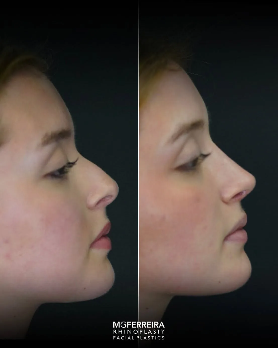 Rinoplastia em nariz curto com giba, perfil