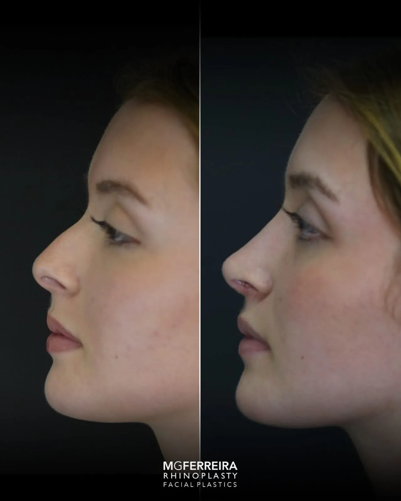 Rinoplastia em nariz curto com giba, perfil oposto