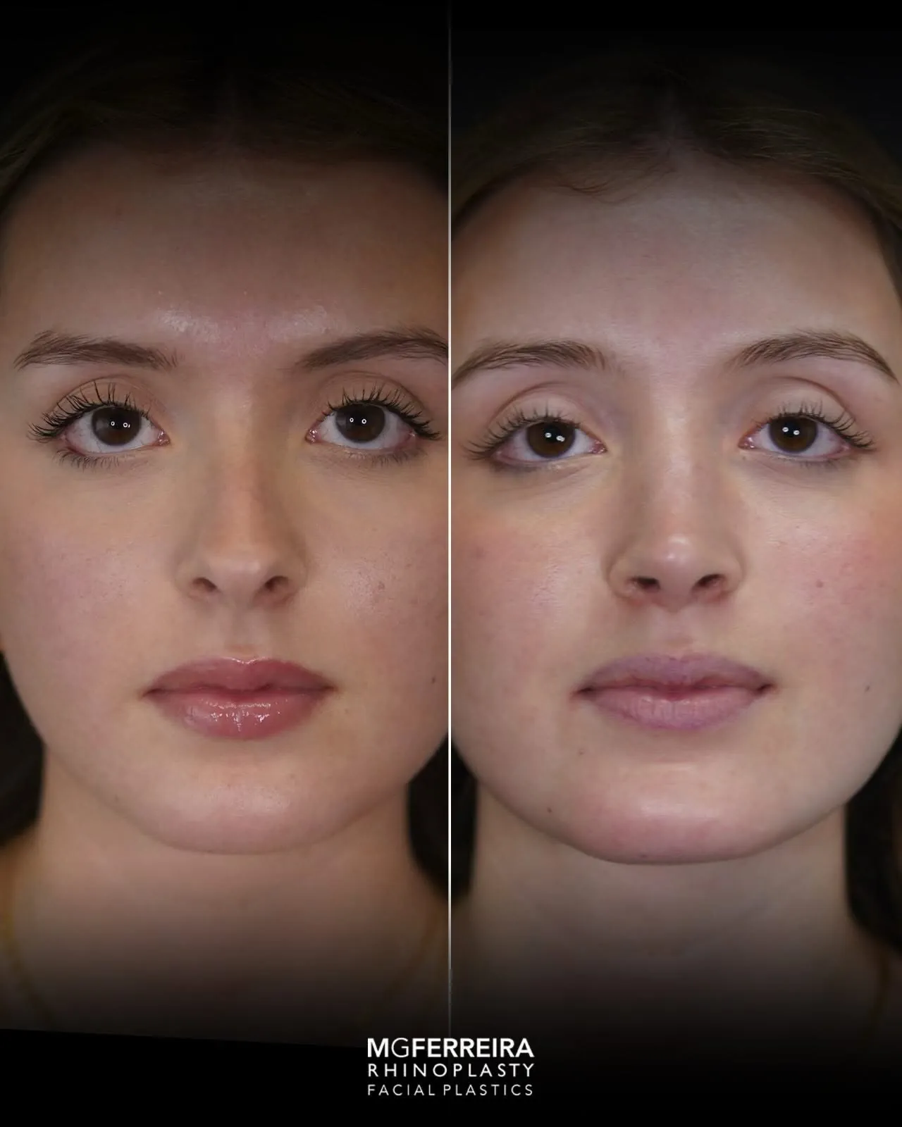 Rinoplastia em nariz curto com giba, vista frontal