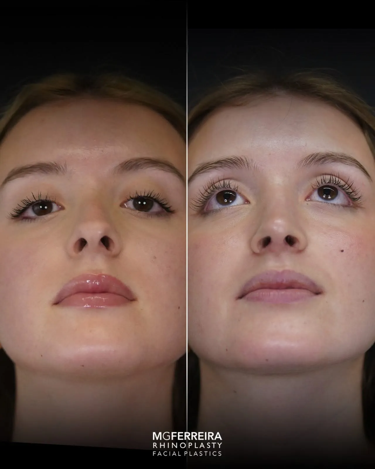Rinoplastia em nariz curto com giba, vista inferior