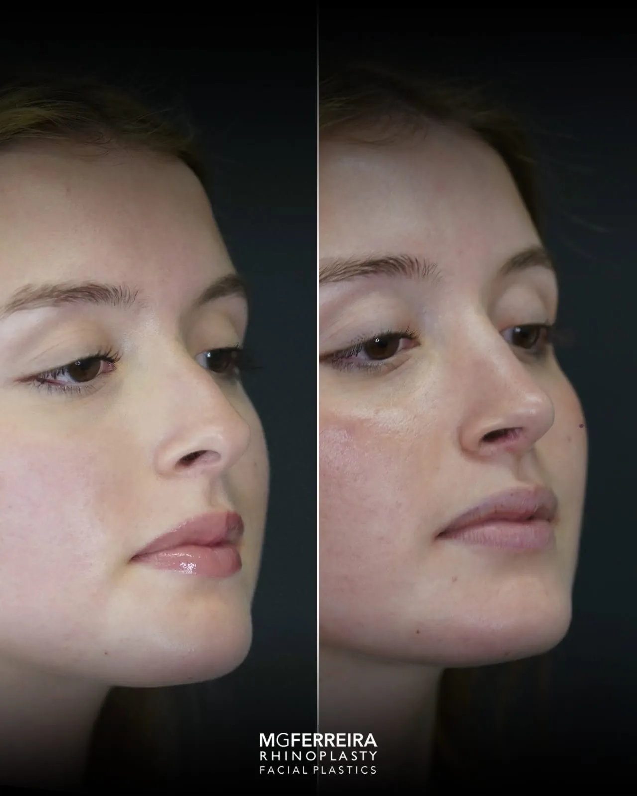 Rinoplastia em nariz curto com giba, vista oblíqua