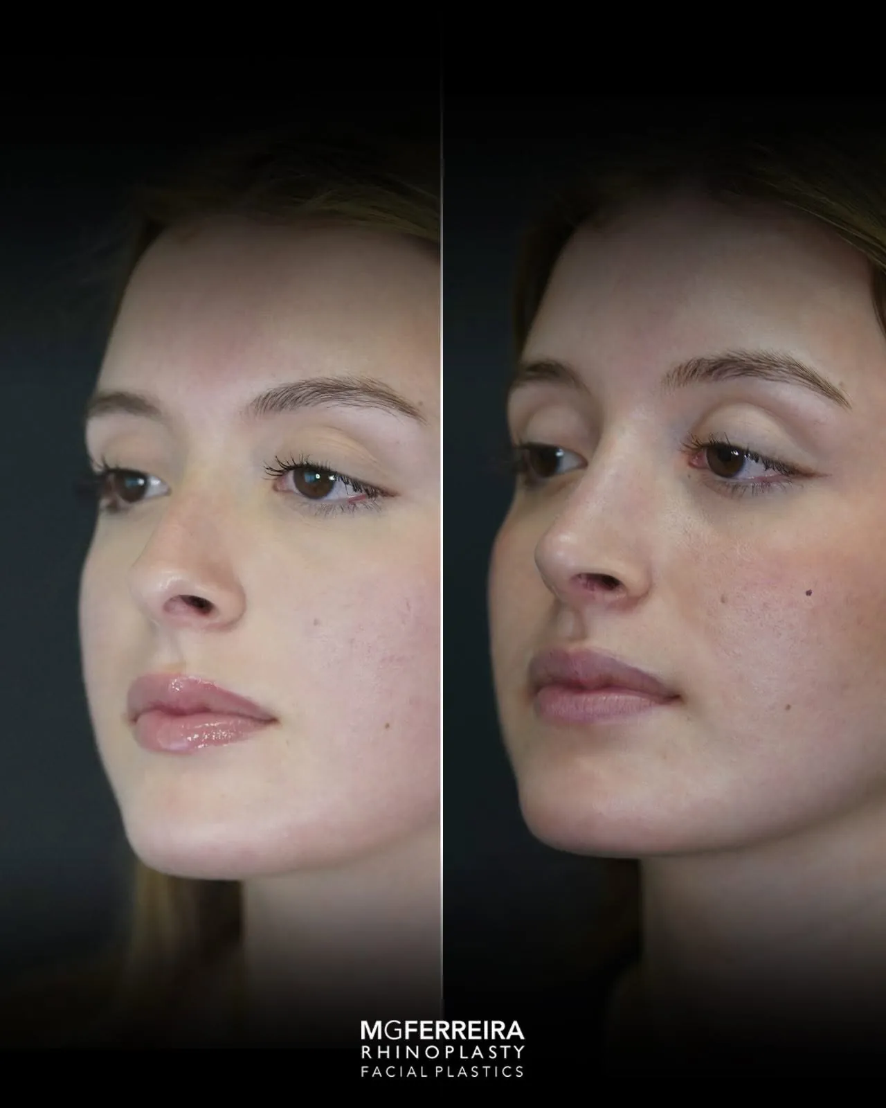 Rinoplastia em nariz curto com giba, vista oblíqua oposta