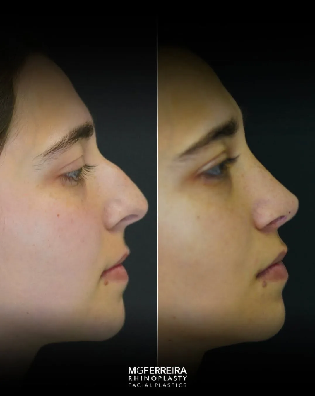 Rinoplastia em nariz curto: equilíbrio do dorso e da ponta, perfil