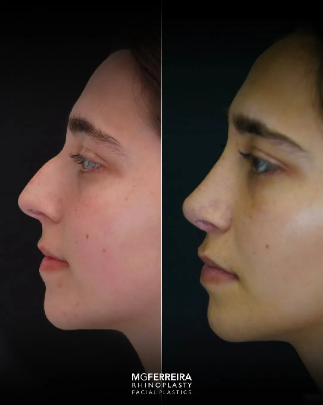 Rinoplastia em nariz curto: equilíbrio do dorso e da ponta, perfil oposto
