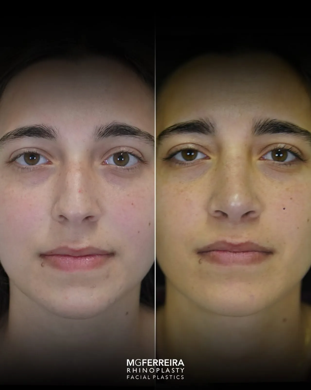 Rinoplastia em nariz curto: equilíbrio do dorso e da ponta, vista frontal
